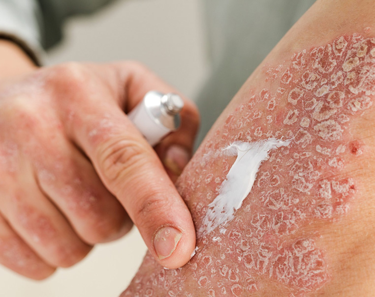 Ayurvedic Treatment For Psoriasis and Eczema